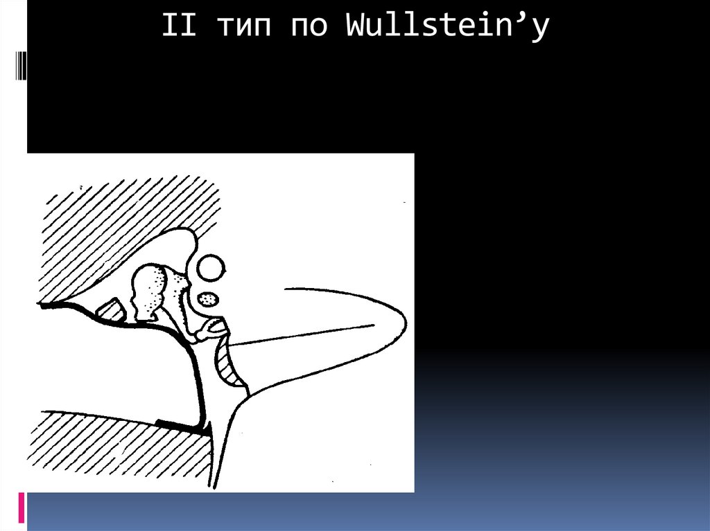 II тип по Wullstein’у