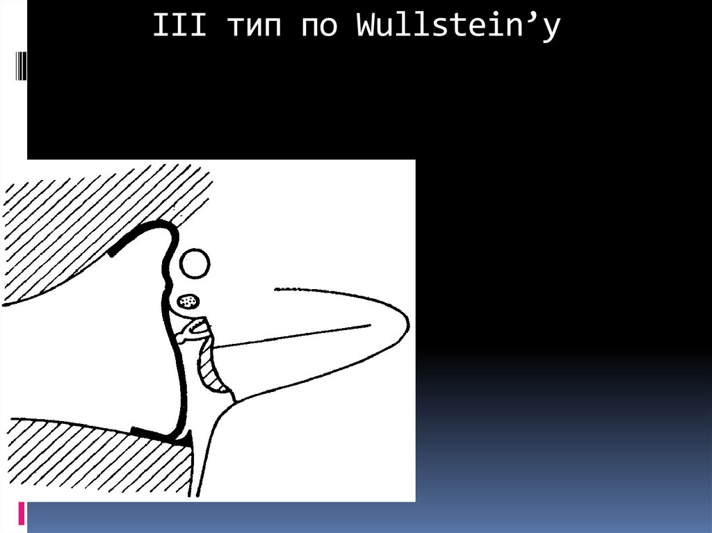 III тип по Wullstein’у