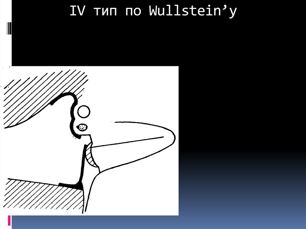 IV тип по Wullstein’у