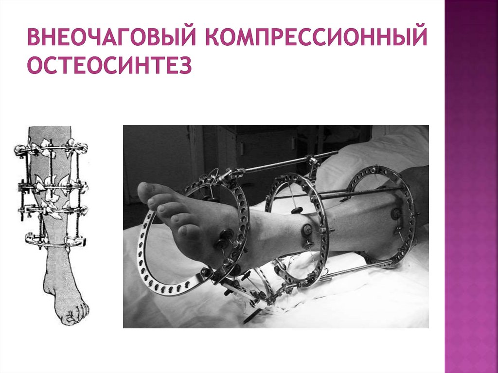 Внеочаговый компрессионный остеосинтез