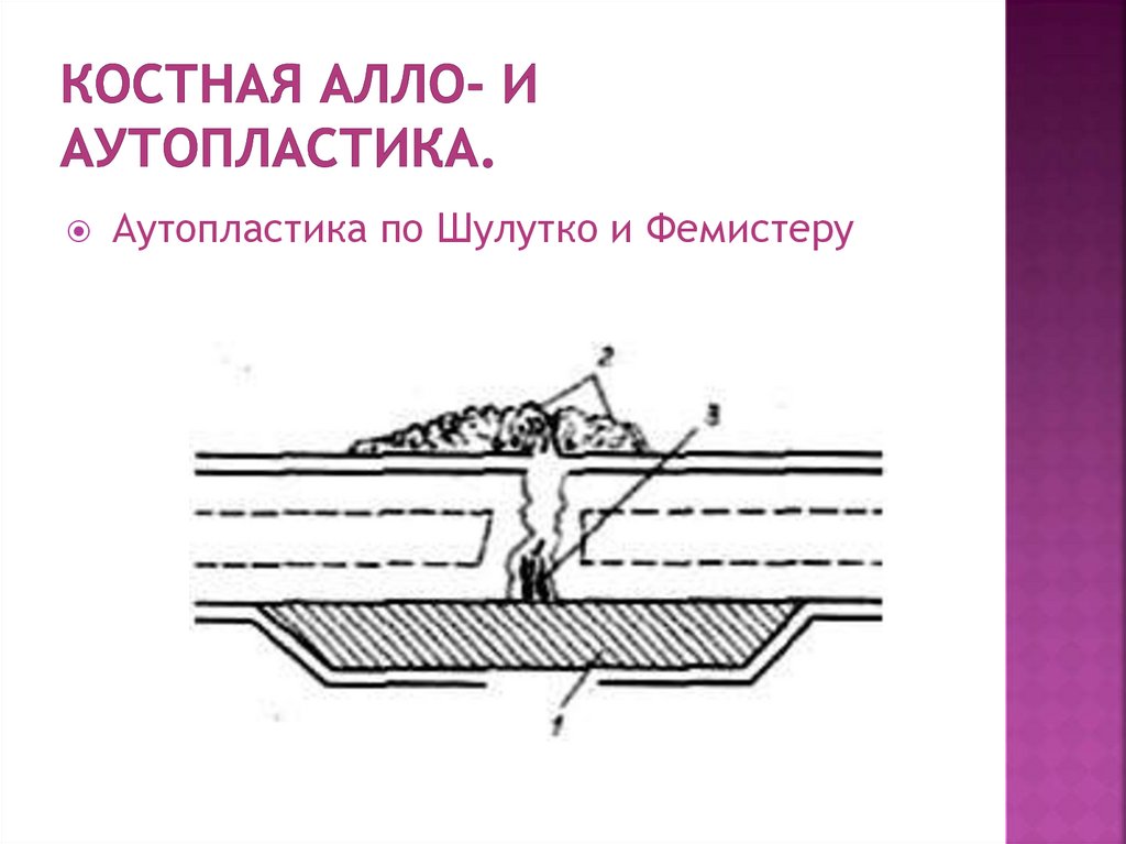 Костная алло- и аутопластика.