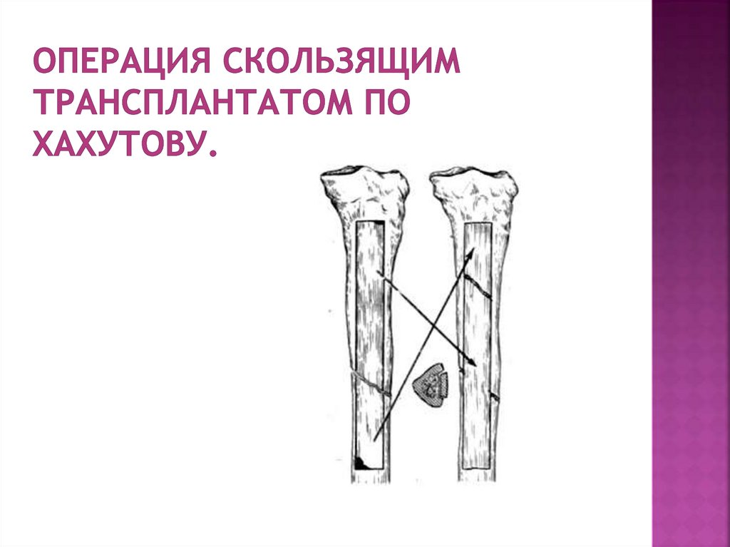 Операция скользящим транспланта­том по Хахутову.