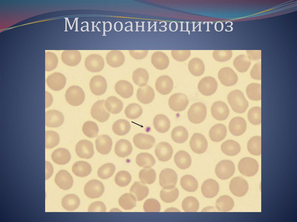 Микроанизоцитоз, гипохромия эритроцитов