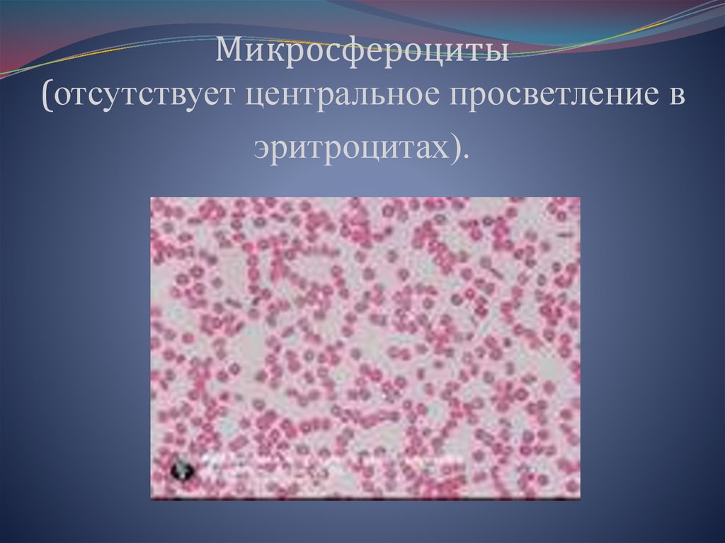 Макроанизоцитоз