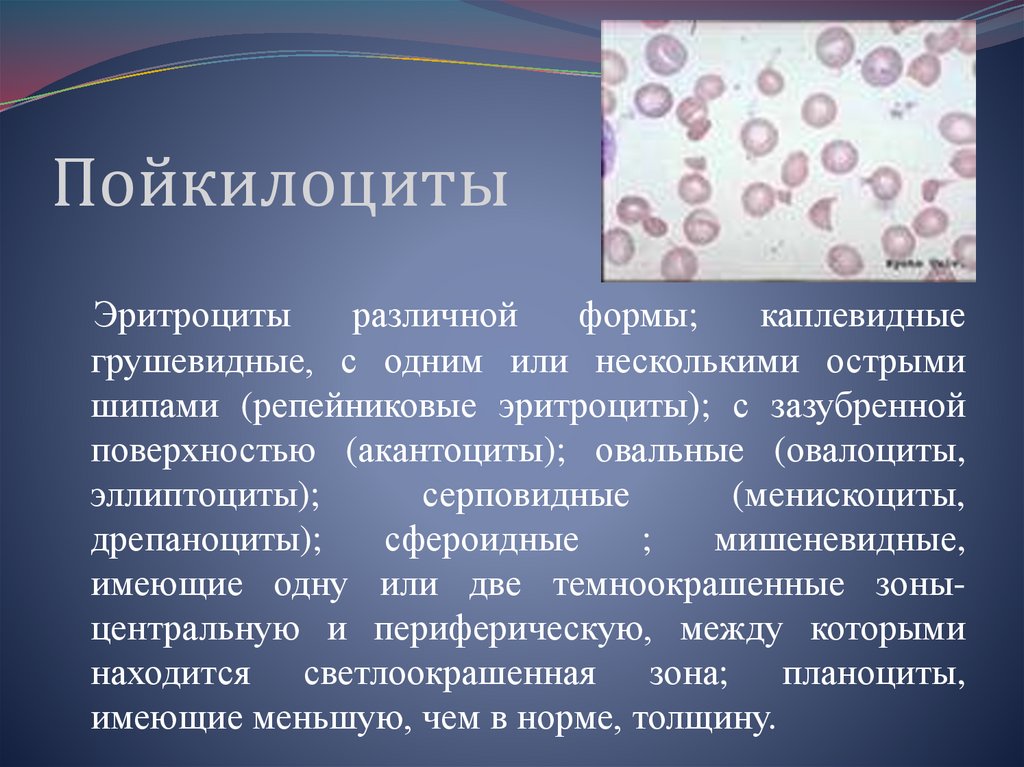 Микросфероциты (отсутствует центральное просветление в эритроцитах).