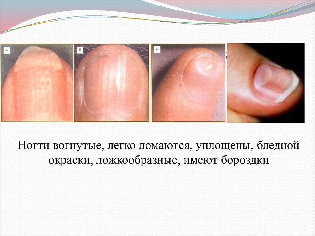 Клинические проявления анемии