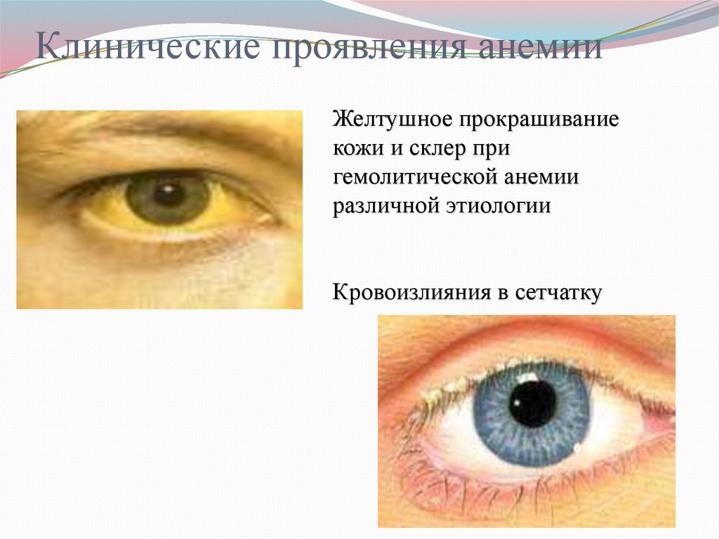 Клинические проявления анемии