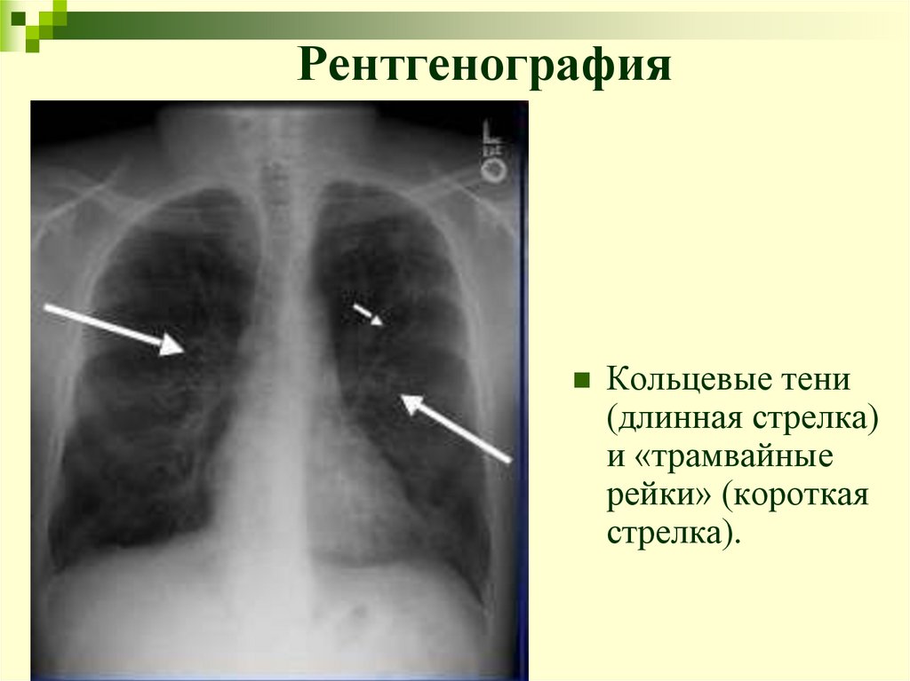 Рентгенография