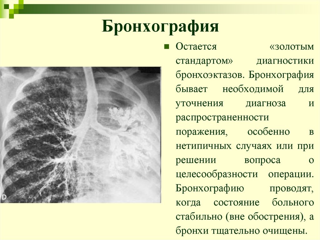 Бронхография