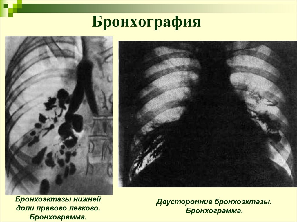 Бронхография