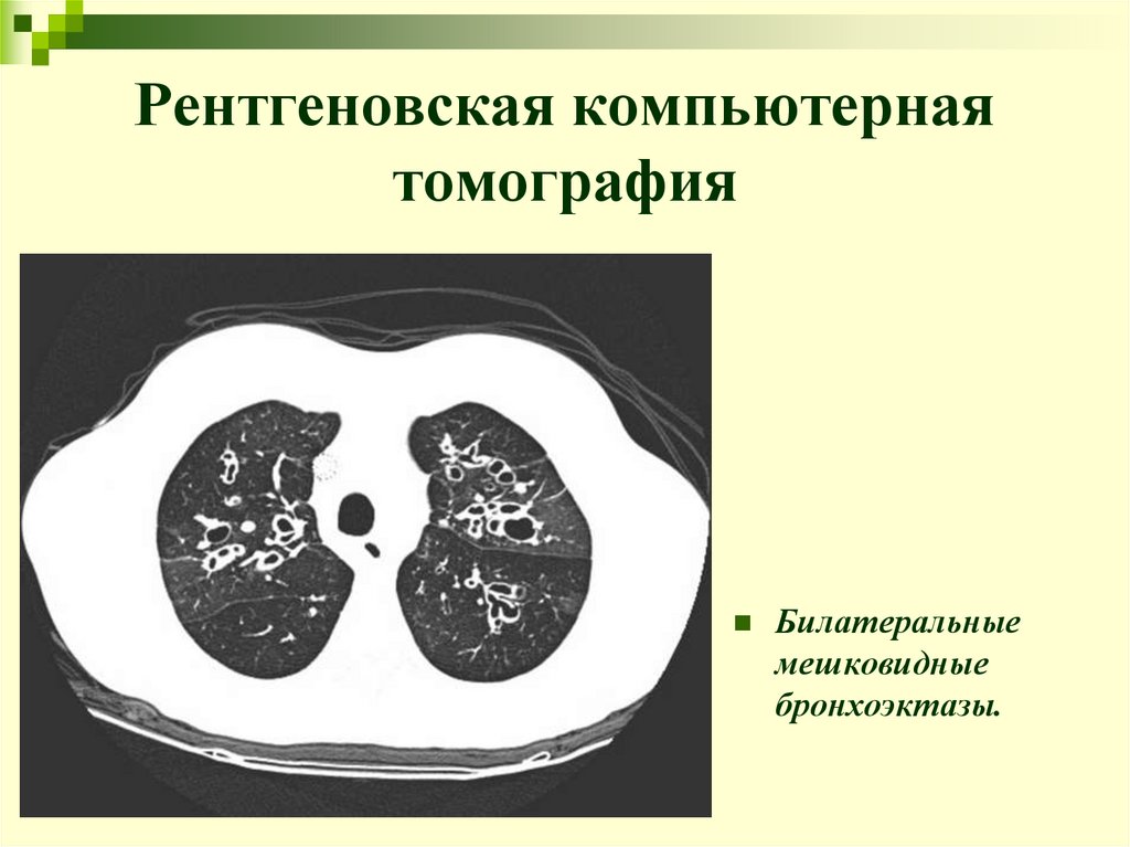 Рентгеновская компьютерная томография