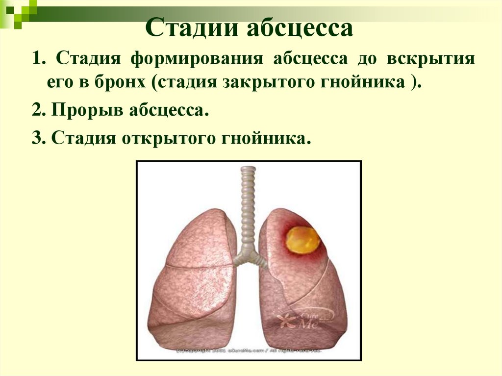 Стадии абсцесса