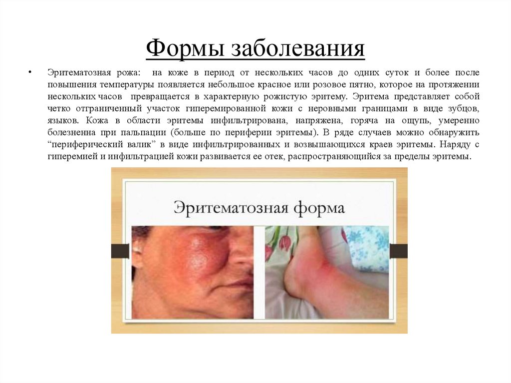 Формы заболевания