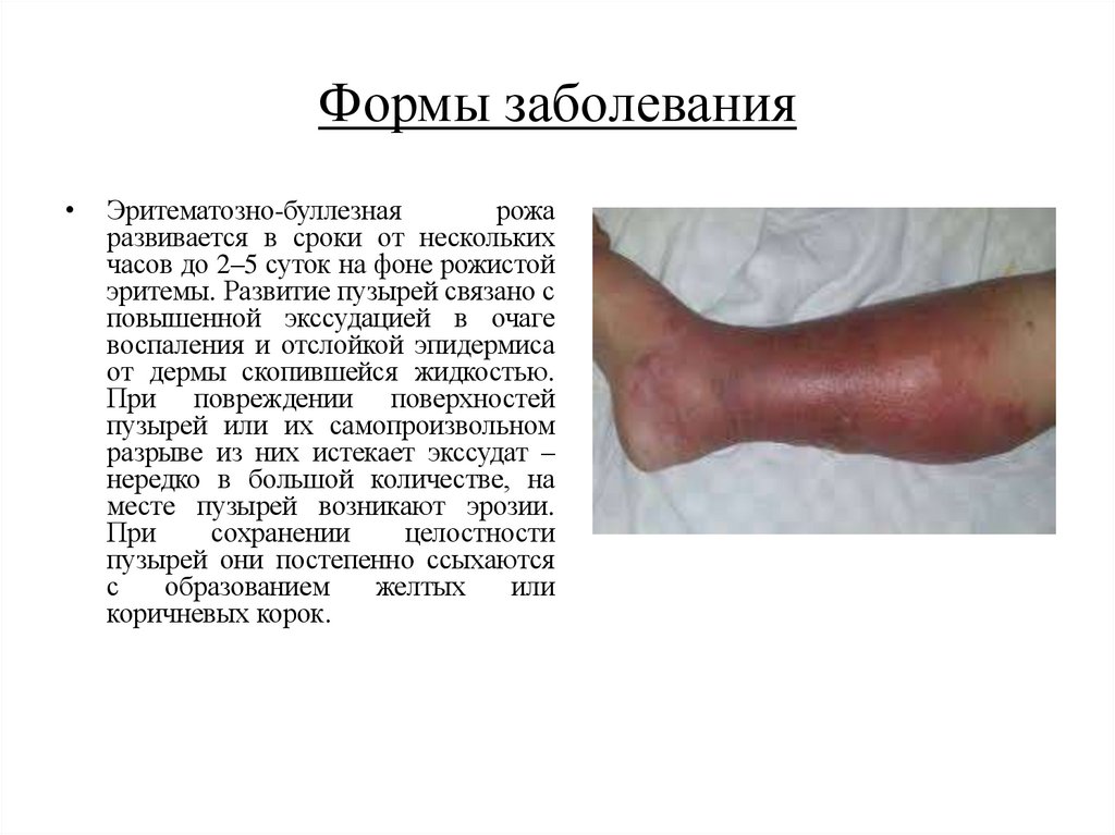 Формы заболевания