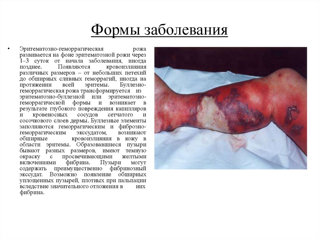 Формы заболевания