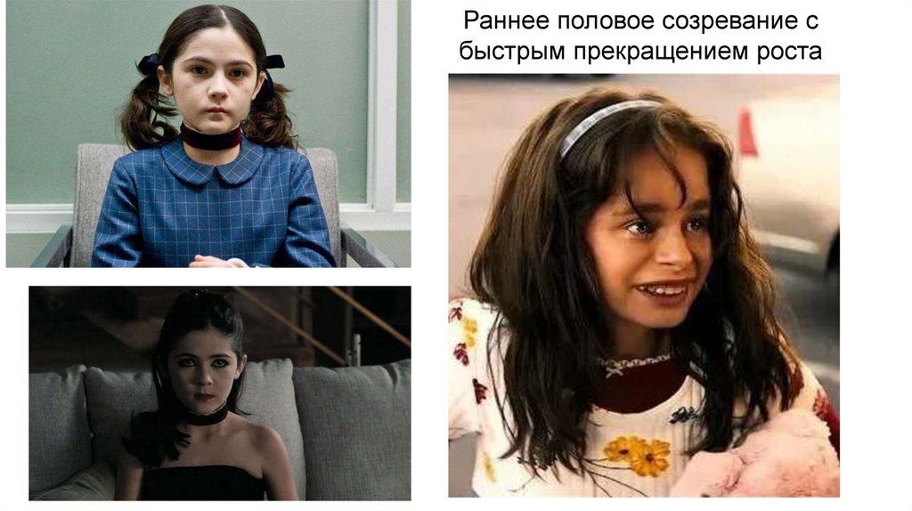 Раннее половое созревание с быстрым прекращением роста