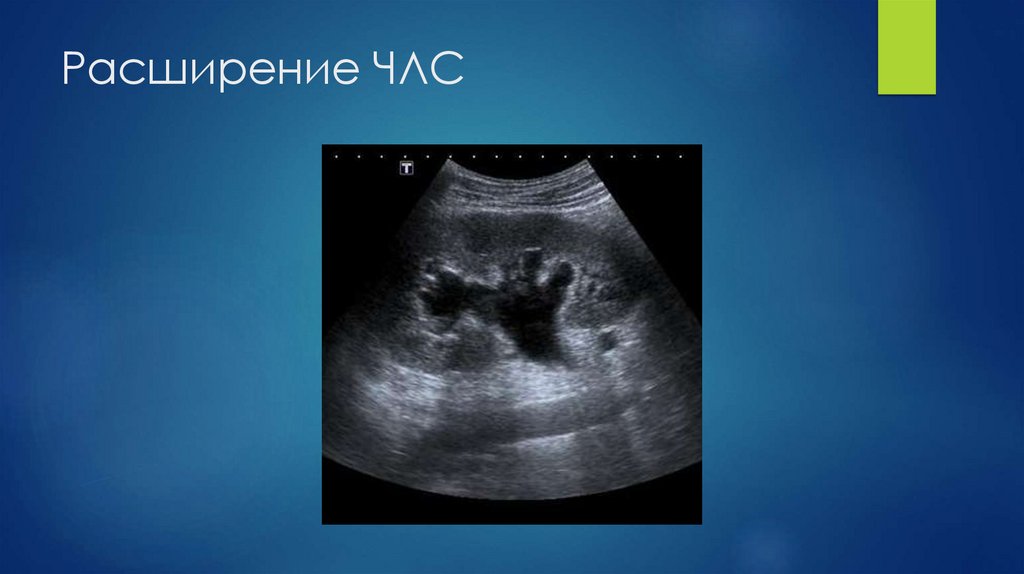 Расширение ЧЛС