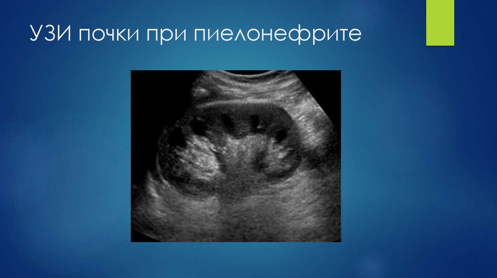 УЗИ почки при пиелонефрите