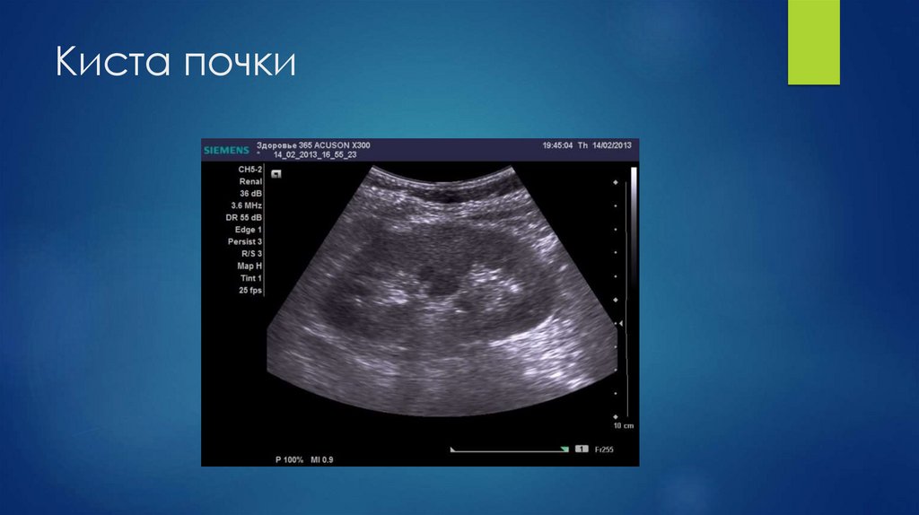 Киста почки