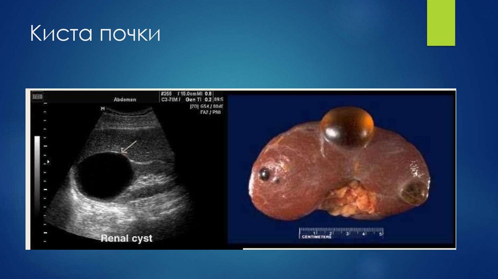 Киста почки