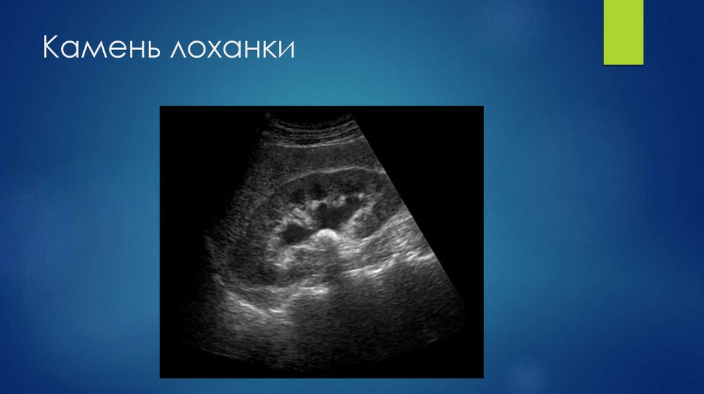 Камень лоханки