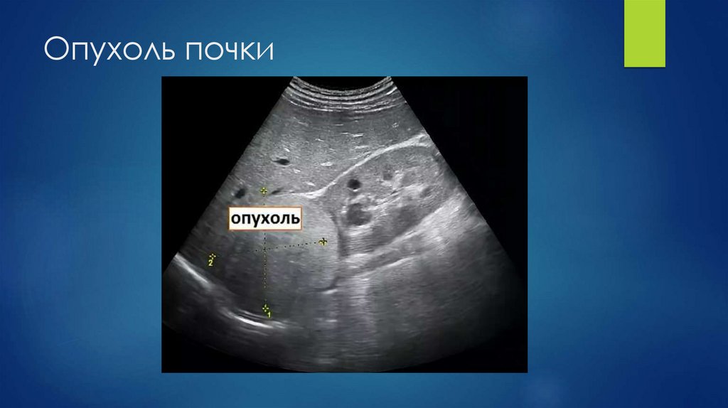 Опухоль почки