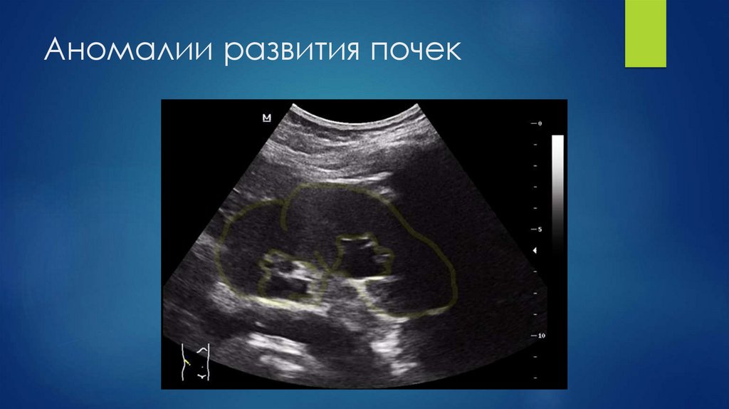 Аномалии развития почек