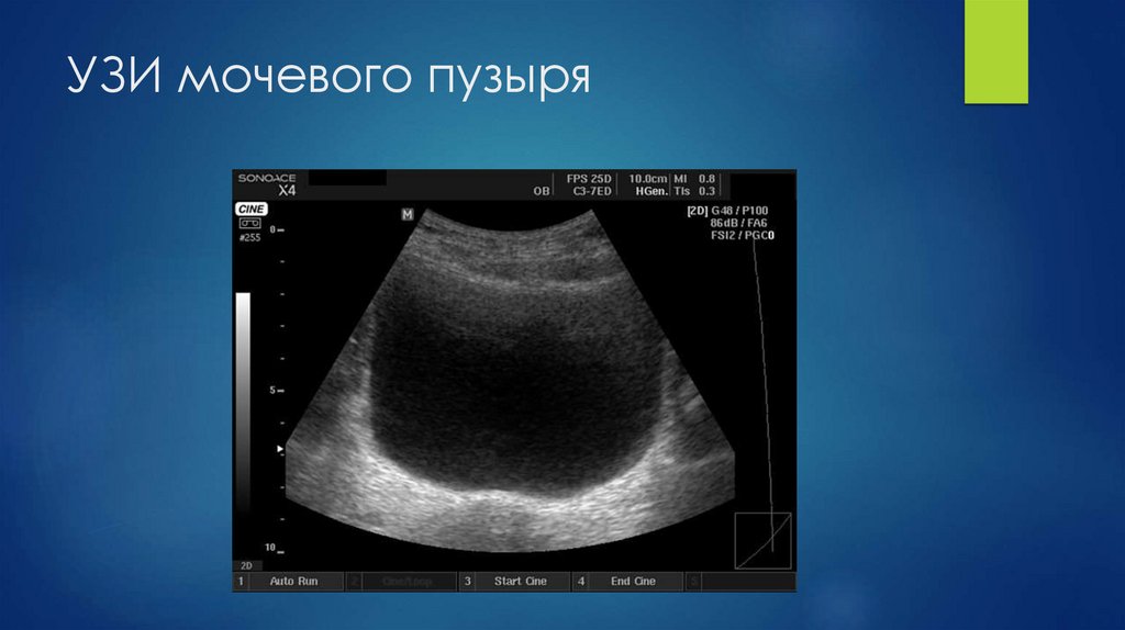 УЗИ мочевого пузыря