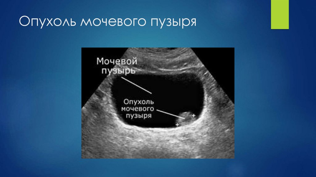 Опухоль мочевого пузыря