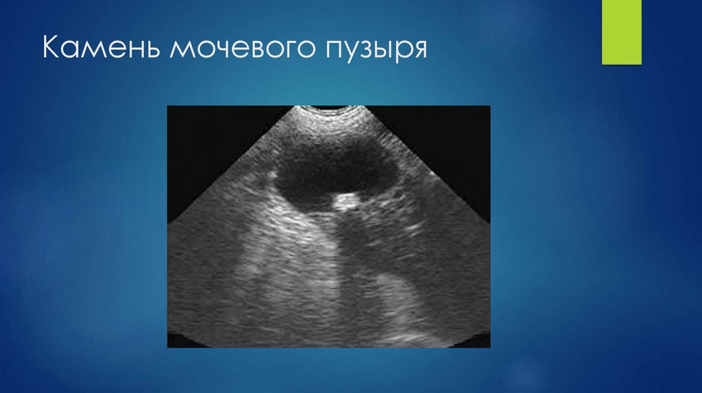 Камень мочевого пузыря