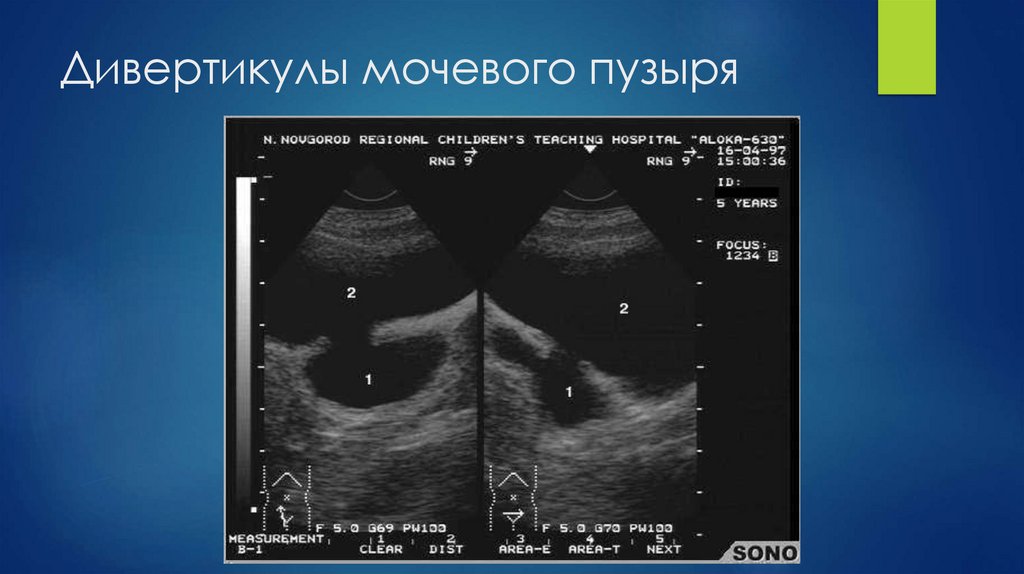 Дивертикулы мочевого пузыря