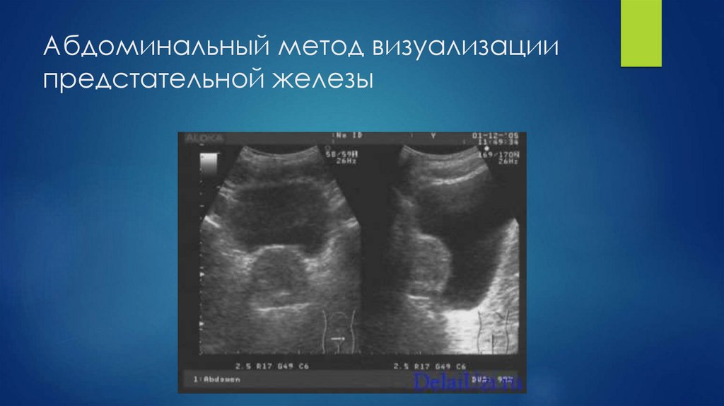 Абдоминальный метод визуализации предстательной железы