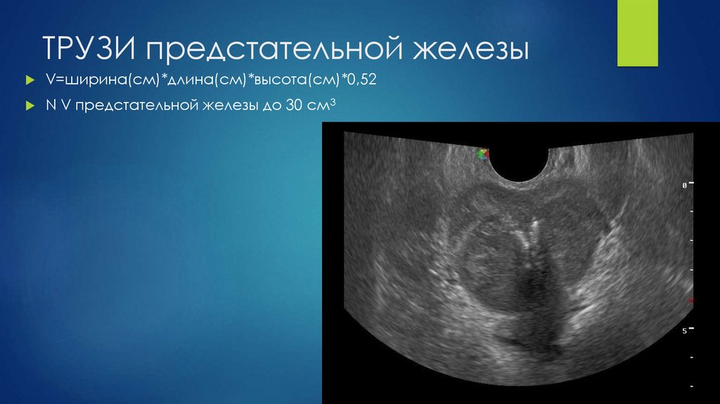 ТРУЗИ предстательной железы