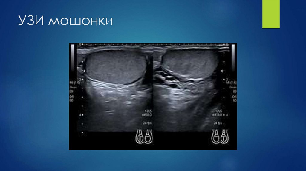 УЗИ мошонки