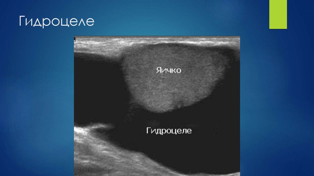 Гидроцеле