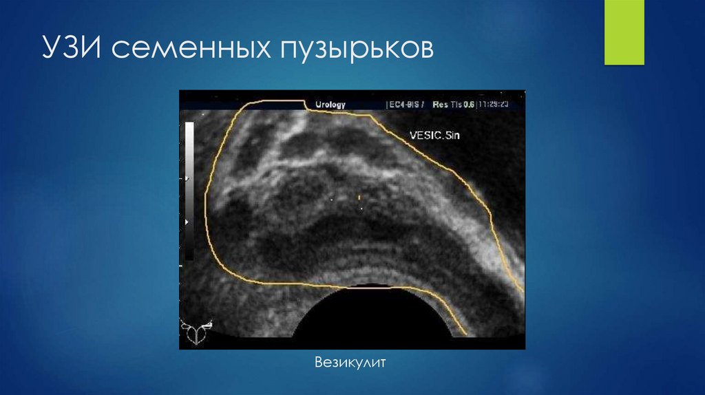 УЗИ семенных пузырьков