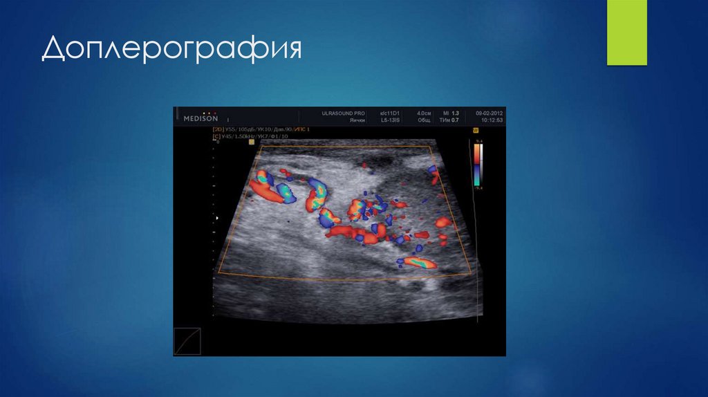 Доплерография