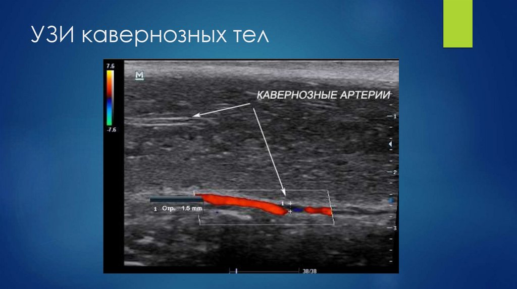 УЗИ кавернозных тел
