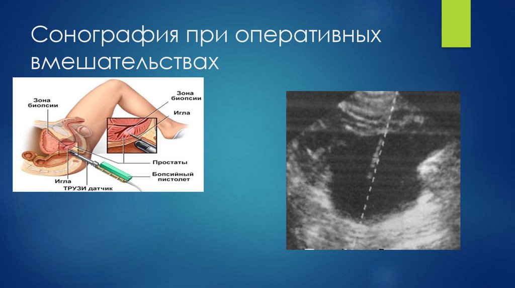 Сонография при оперативных вмешательствах
