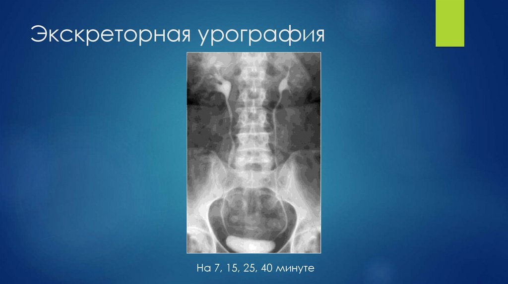 Экскреторная урография