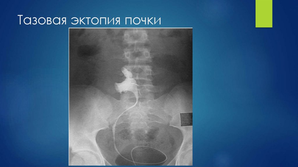 Тазовая эктопия почки