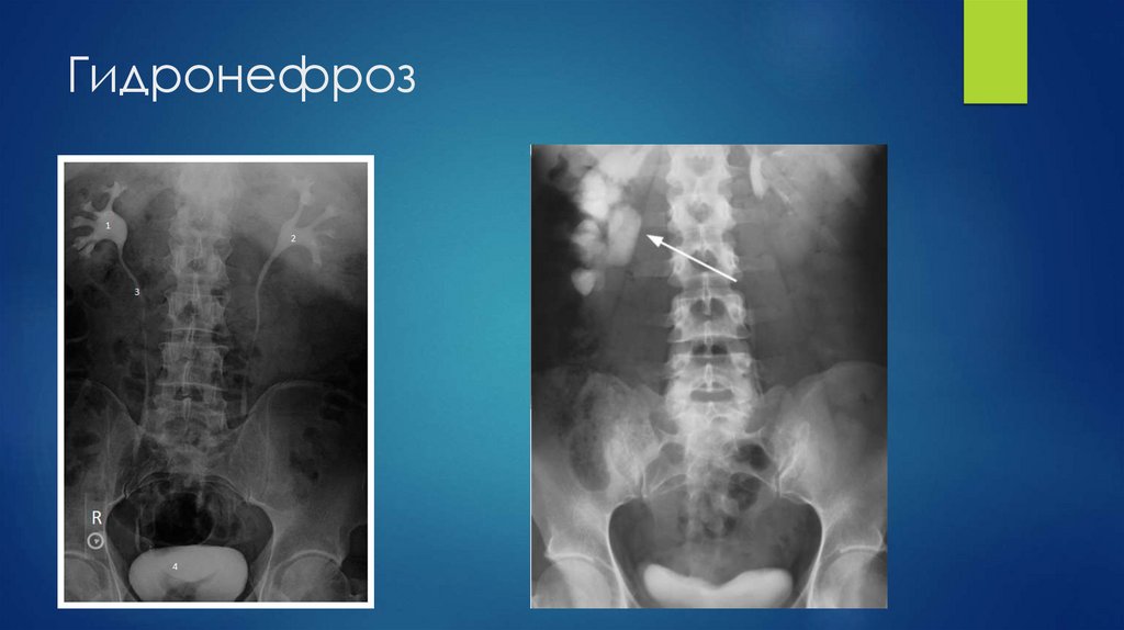 Гидронефроз