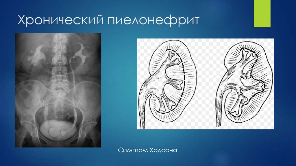 Хронический пиелонефрит