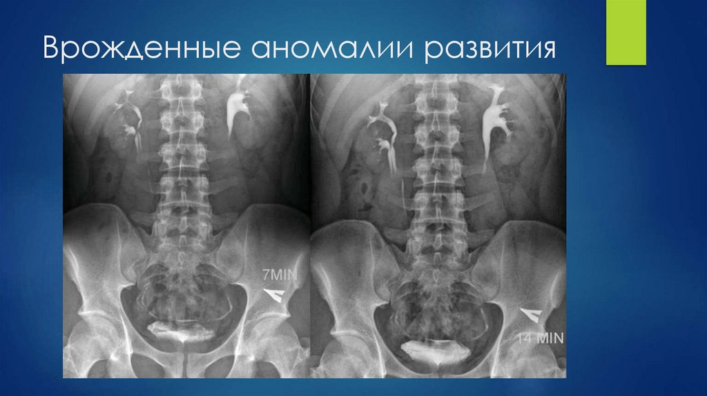 Врожденные аномалии развития