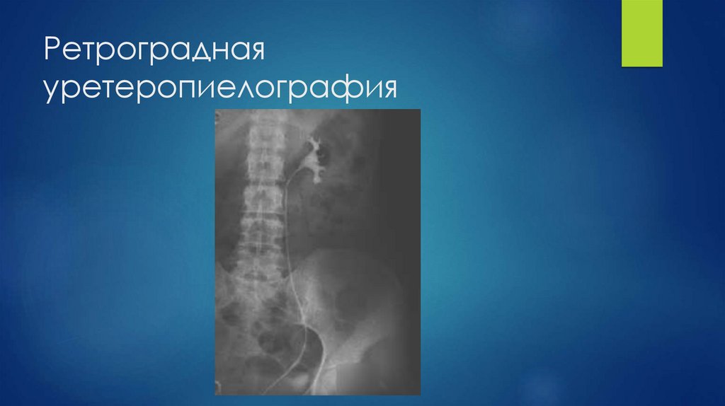 Ретроградная уретеропиелография