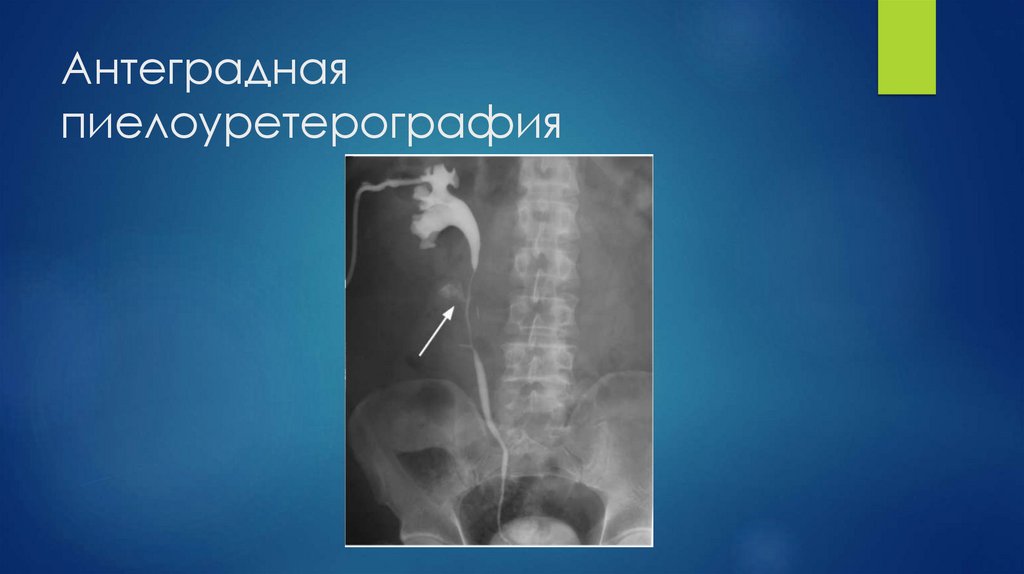 Антеградная пиелоуретерография