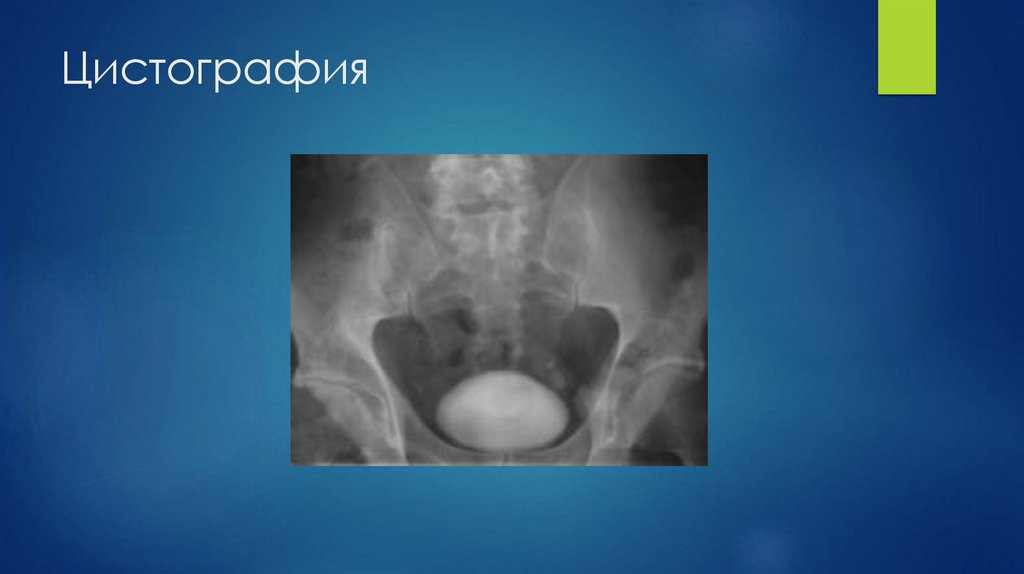 Цистография