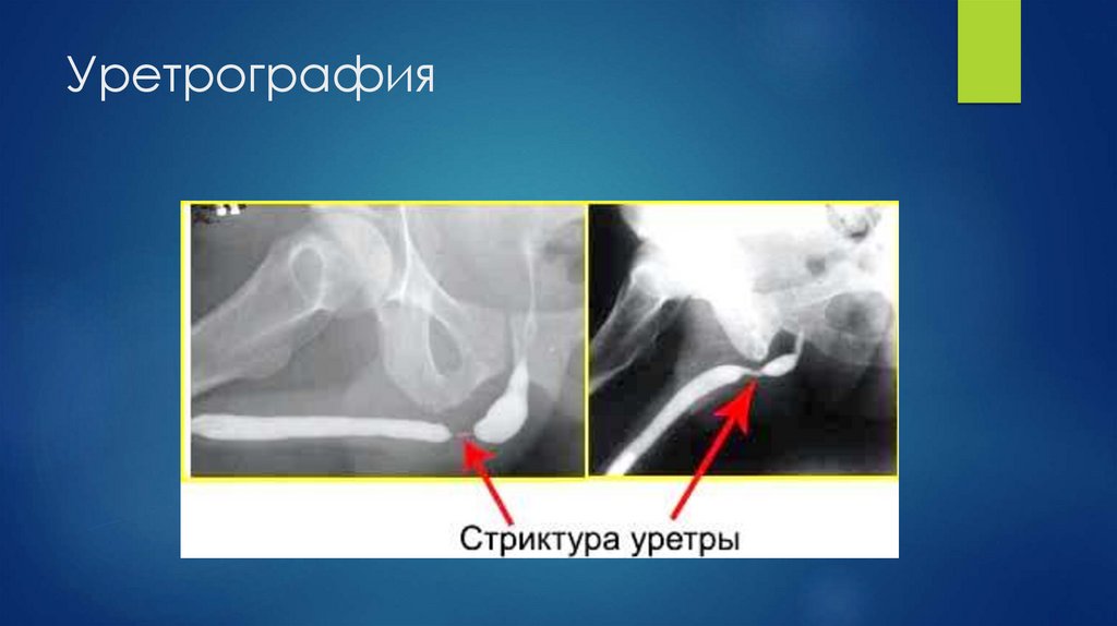 Уретрография