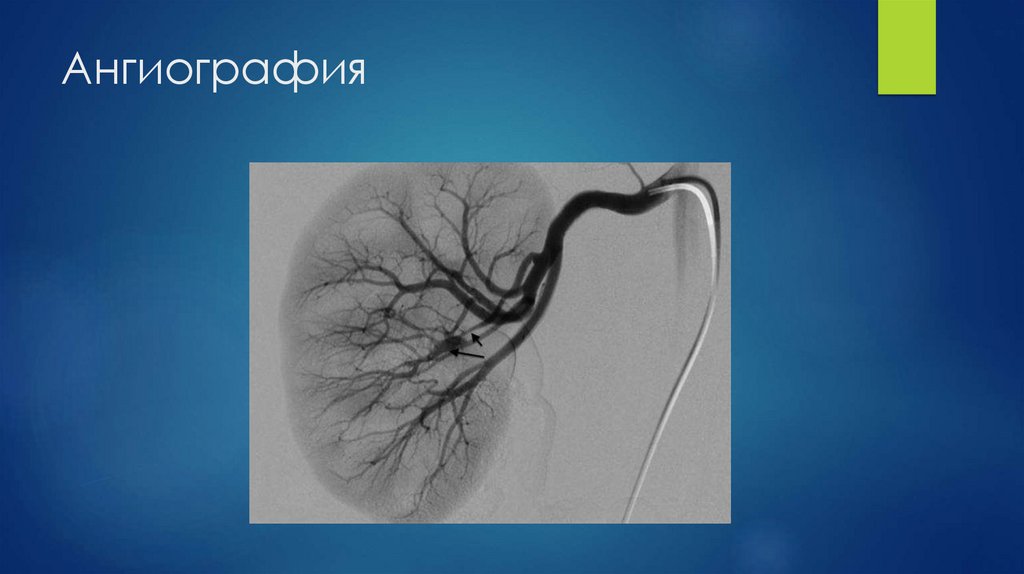 Ангиография