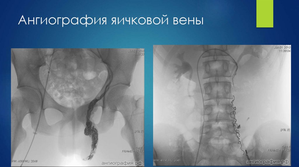 Ангиография яичковой вены